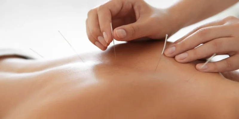 acupuncture services near me